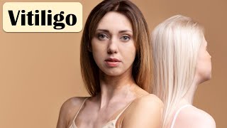 Vitiligo  Causes Pathogenesis Signs amp Symptoms And Treatment [upl. by Richman345]