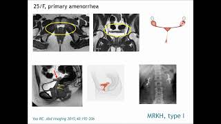 Mullerian duct anomaliestKRadiology Tutorial [upl. by Hannahsohs789]