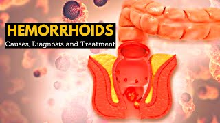 Hemorrhoids or Piles CausesSigns and symptoms Diagnosis and Treatment [upl. by Bolme56]