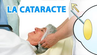 La cataracte expliquée par Dr Stopek [upl. by Aimik]