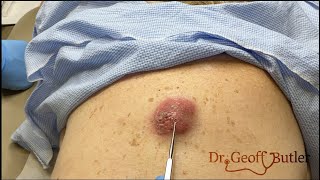 Drainage of an infected cyst on the back [upl. by Holzman599]