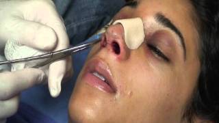 The Kotler Nasal Airway  Removal of the Airway [upl. by Niwrad]