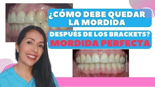 ¿Cómo debe quedar la mordida despues de los brackets Mordida perfecta [upl. by Larrabee]