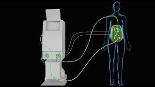 HIPEC Heated Intraperitoneal Chemotherapy [upl. by Potts322]