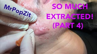 So much extracted Severe acne before and after Session 2 Comedones for days [upl. by Housum]