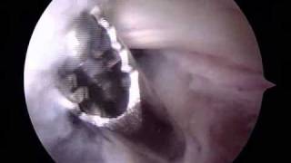 Arthroscopic Removal of Bakers Cyst  ORV  Raymond Whitehead MD [upl. by Schwejda]