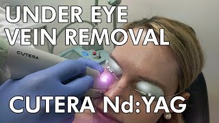 Under Eye Vein Removal Cutera NdYAG Laser  Dr Paul Ruff  West End Plastic Surgery [upl. by Occor790]