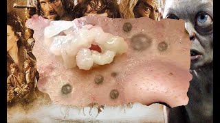 Pimple Popping Blackheads On Skin 😲😲 [upl. by Annahahs]