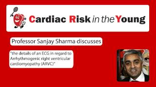 ECG 7 Arrhythmogenic right ventricular cardiomyopathy ARVC [upl. by Sacram]