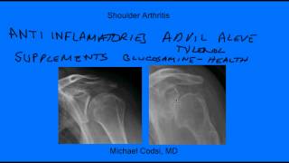 Shoulder arthritis [upl. by Joye]