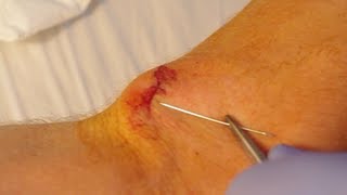 How To Give Yourself Stitches Sutures [upl. by Eiramanna]