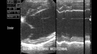 ECOCARDIOGRAFIA CARDIOMIOPATIA DILATADA [upl. by Edme]