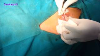 Large Infected Sebaceous Cyst Evacuated [upl. by Noillid]