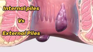 BAADI BAVASIR Vs Khooni Bawasir  Which are different types of Piles amp Haemorrhoids  Piles meaning [upl. by Nauht]