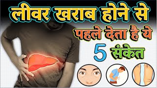 लीवर खराब होने के 5 लक्षण और इलाज  6 Warning signs of LIVER damage [upl. by Eeneg]