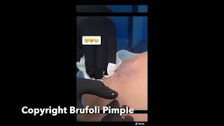 Drainage of an inflamedinfected cyst on the back cysticfibrosis popping blackheads drainage [upl. by Enileqcaj]