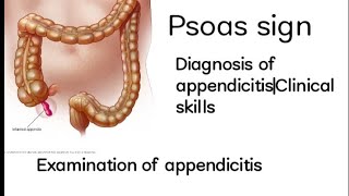 Psoas signExamination of appendicitisDiagnosis of appendicitisClinical skills appendicitis [upl. by Malva780]