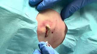 Inflamed Cyst Drainage [upl. by Artek59]