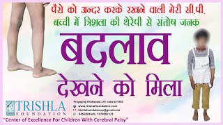 How to Treat Spastic Diplegic Cerebral Palsy Affected Child with Surgery amp Therapy  Trishla Hindi [upl. by Eaj]