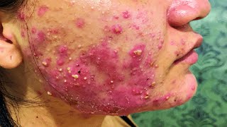 Acne Vulgaris How to Clear and treatments [upl. by Freed]