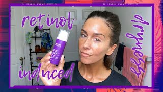 TIPS FOR DRY  PEELING SKIN WHEN USING RETINOL [upl. by Dickman]