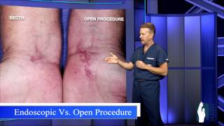 Carpal Tunnel Release  Open Procedure vs Endoscopic [upl. by Marozas320]