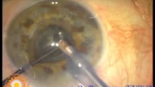 pseudoexfoliation cataract surgeryFAKOIOL DR İbrahim TAŞKIN ADANA MAYA GÖZ [upl. by Cence]