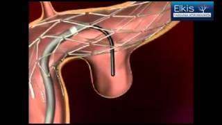 Embolização Vascular  Aneurisma Cerebral [upl. by Jackqueline]