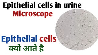 Causes of Epithelial Cells in Urine I Epithelial cells in urine [upl. by Vinn638]