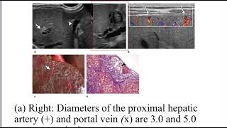 Biliary atresia ultrasound [upl. by Milstone999]