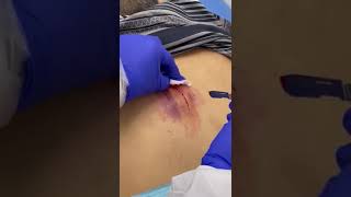 Back Sebaceous Cyst Removal [upl. by Papageno]