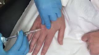 How to have younger looking hands with a Skin Booster Treatment [upl. by Mcclenon]