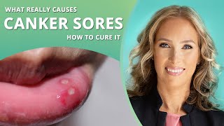 Canker Sores  How to Get Rid of Canker Sores  Dr J9 Live [upl. by Anabella]