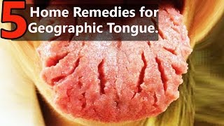 Top 5 Home Remedies for Treating Geographic Tongue  By Top 5 [upl. by Doty]