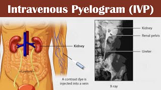 Intravenous pyelogram IVP [upl. by Yeldahc945]