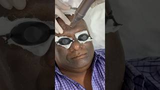 Dark Black skin Removal from Face using Laser [upl. by Aihsele]