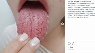 What is a Fissured Tongue Cracked Tongue [upl. by Khai]