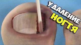 ▶ Симулятор удаления вросшего ногтя Ingrown Toenail Surgery [upl. by Kirsten]