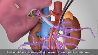 Total pancreatectomy with splenectomy duodenectomy and reconstruction of PV to 2 branches of SMV [upl. by Reagan872]