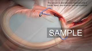 Shoulder arthroscopy stock 3D animation [upl. by Eyssej]