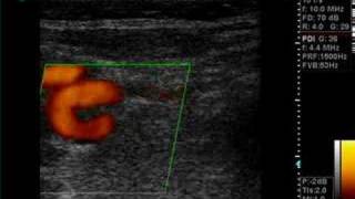 looping carotid [upl. by Assetniuq316]