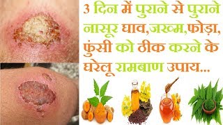 3 दिन में पुराने से पुराने घाव जख्म फोड़ा ठीक करने का सरल उपायTreatment Of Chronic wounds JMD [upl. by Tarryn94]