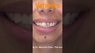 Composite Veneers by the World Best Dr Mauricio Soto [upl. by Aener]