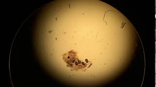 Scabies Mite eggs scybala [upl. by Robena807]