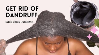 How to Get Rid of Dandruff Instantly [upl. by Eseer86]