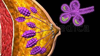 Epithelial Hyperplasia of the Breast  Animated Atlas of Breast and Gastric Cancer [upl. by Austreng]