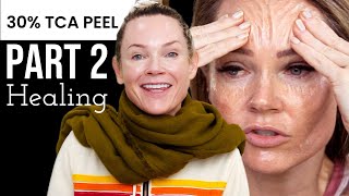 Part 2 TCA RECOVERY post care after chemical peel Before and After [upl. by Naret]