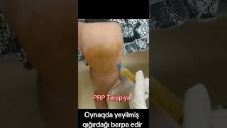 prptherapy dizağrısı arthrosis [upl. by Aicercal]