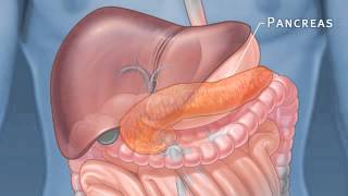 Pancreatic Auto Islet Transplantation with Total Pancreatectomy [upl. by Llenahc]