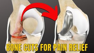 Knee Pain Gone Best 2 Options for Knee Arthritis Pain [upl. by Llered]